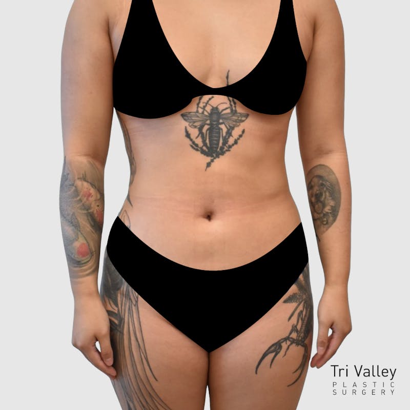 Liposuction Before & After Gallery - Patient 277191 - Image 2
