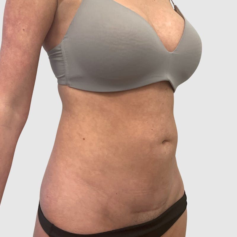 Liposuction Before & After Gallery - Patient 390577 - Image 1