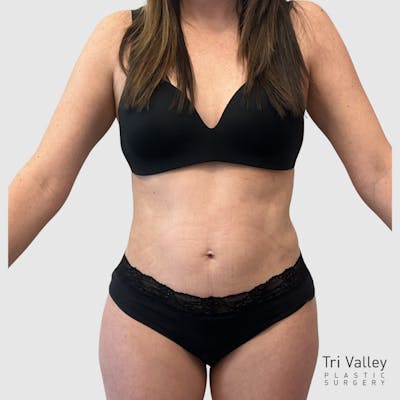 Liposuction Before & After Gallery - Patient 679146 - Image 2