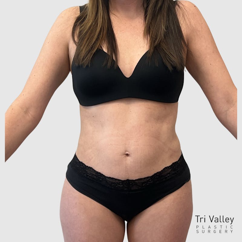 Liposuction Before & After Gallery - Patient 679146 - Image 2