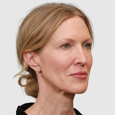 Face and Neck Lifts Before & After Gallery - Patient 895454 - Image 1