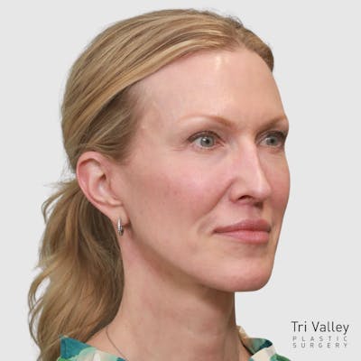 Face and Neck Lifts Before & After Gallery - Patient 895454 - Image 2