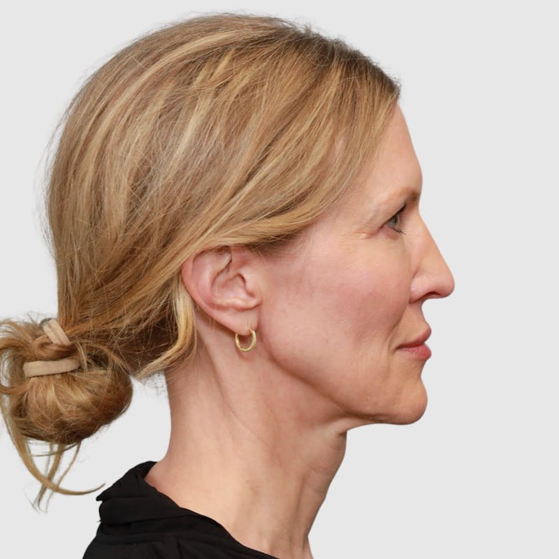 Face and Neck Lifts Before & After Gallery - Patient 895454 - Image 3