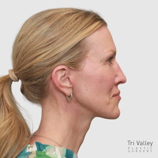 Face and Neck Lifts Before & After Gallery - Patient 895454 - Image 4