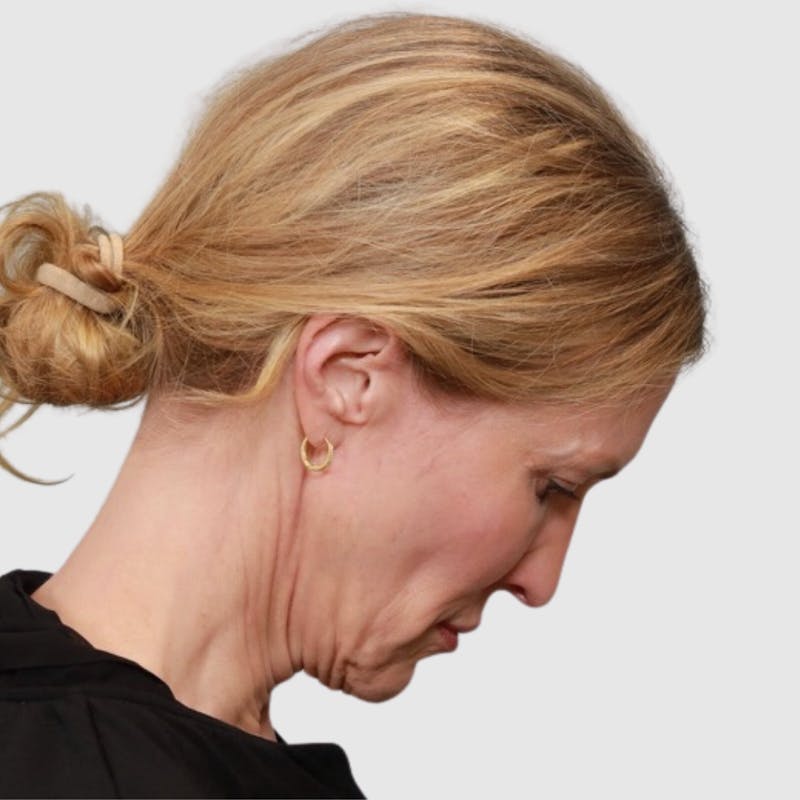 Face and Neck Lifts Before & After Gallery - Patient 895454 - Image 5