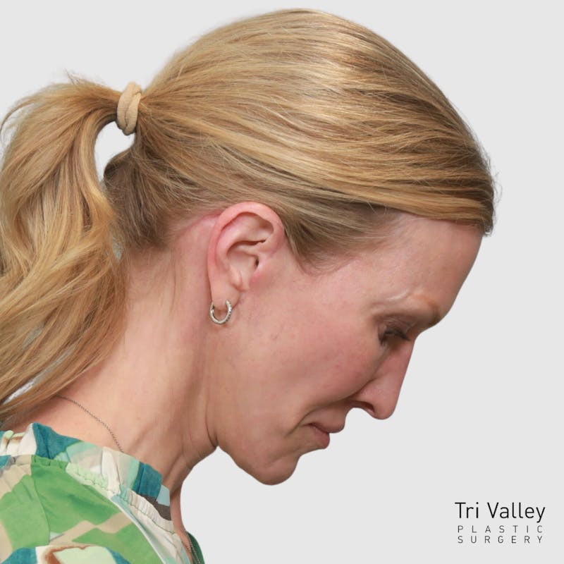Face and Neck Lifts Before & After Gallery - Patient 895454 - Image 6
