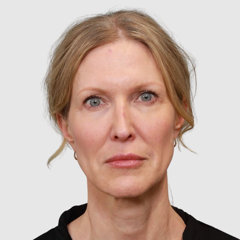 Face and Neck Lifts Before & After Gallery - Patient 895454 - Image 7