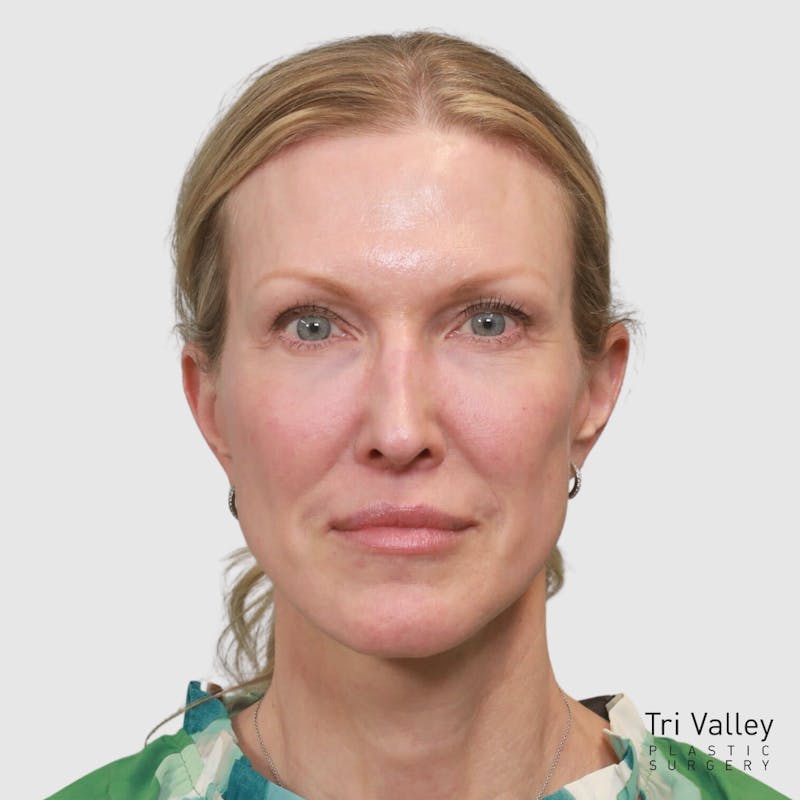 Face and Neck Lifts Before & After Gallery - Patient 895454 - Image 8