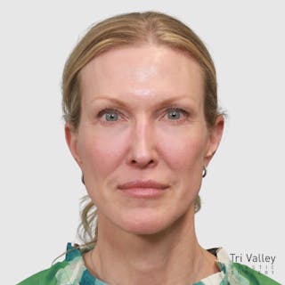 Face and Neck Lifts Before & After Gallery - Patient 895454 - Image 8
