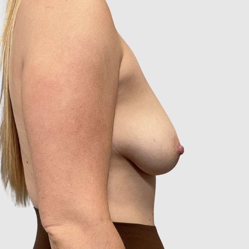 Fat Transfer Breast Augmentation Before & After Gallery - Patient 193190 - Image 3
