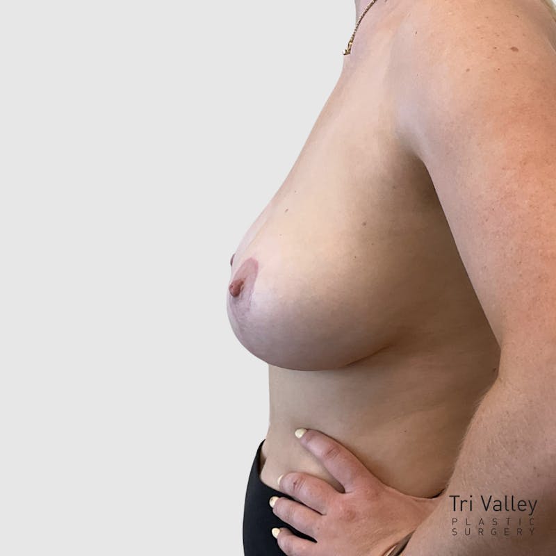 Fat Transfer Breast Augmentation Before & After Gallery - Patient 193190 - Image 6