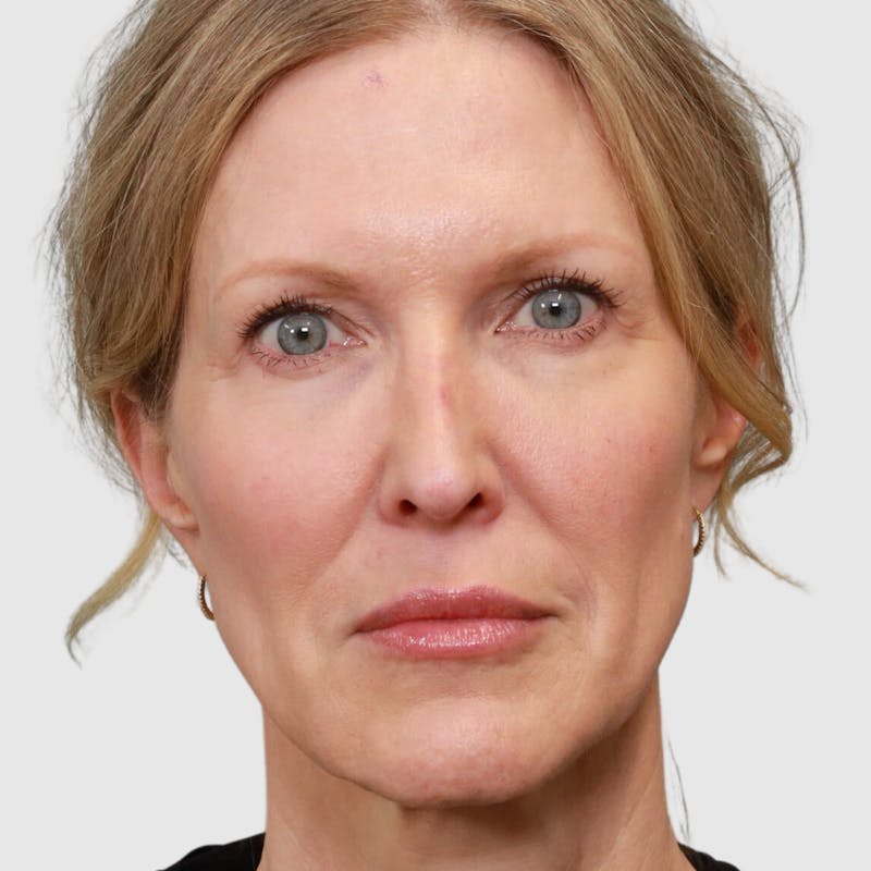 Lip Lift Before & After Gallery - Patient 400729 - Image 1