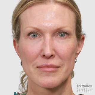 Lip Lift Before & After Gallery - Patient 400729 - Image 2
