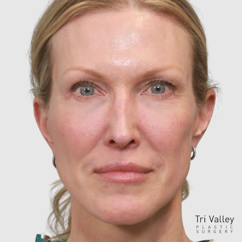 Lip Lift Before & After Gallery - Patient 400729 - Image 2