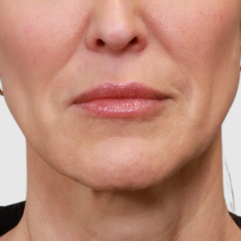 Lip Lift Before & After Gallery - Patient 400729 - Image 3