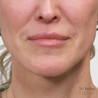 Lip Lift Before & After Gallery - Patient 400729 - Image 4