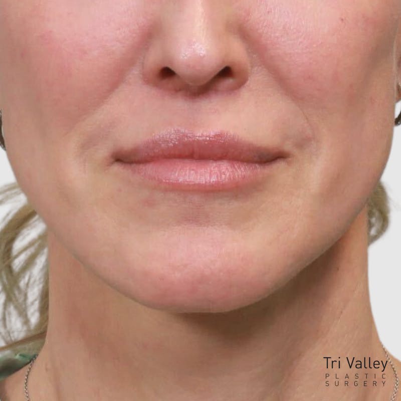 Lip Lift Before & After Gallery - Patient 400729 - Image 4