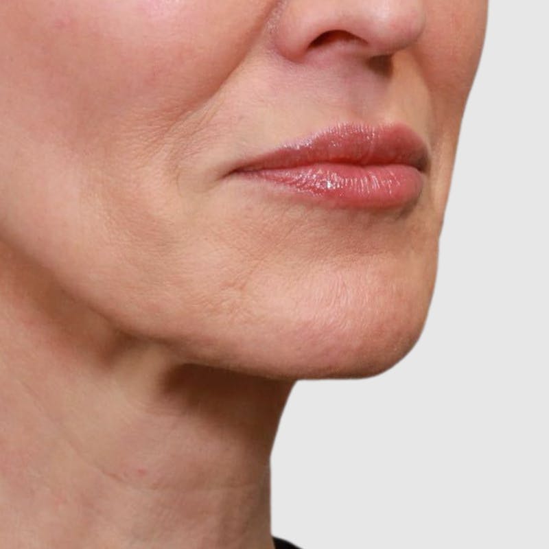 Lip Lift Before & After Gallery - Patient 400729 - Image 5