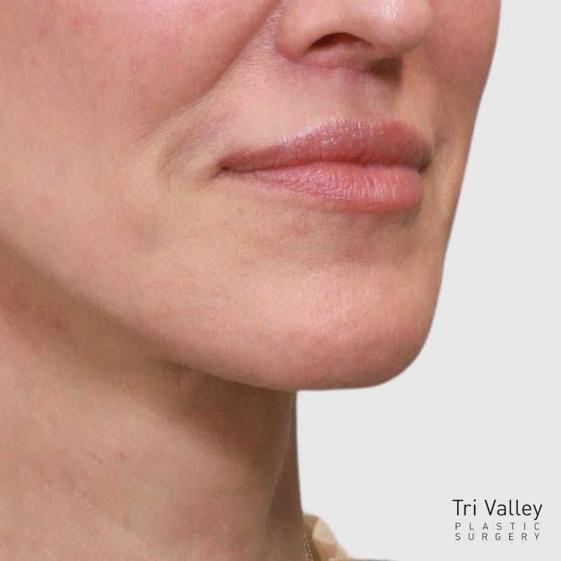 Lip Lift Before & After Gallery - Patient 400729 - Image 6