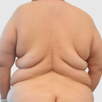 Body Lift Before & After Gallery - Patient 258601 - Image 1