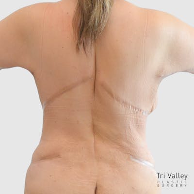 Body Lift Before & After Gallery - Patient 258601 - Image 2