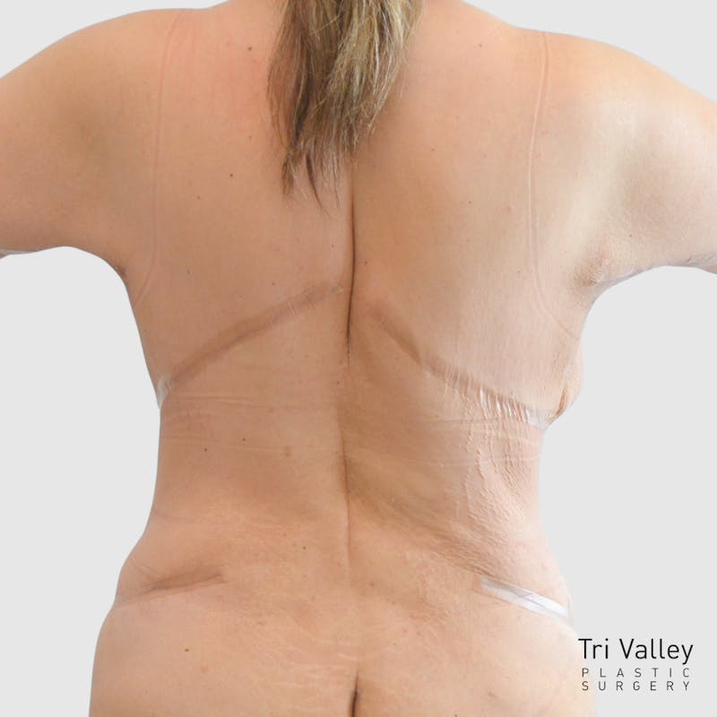Body Lift Before & After Gallery - Patient 258601 - Image 2