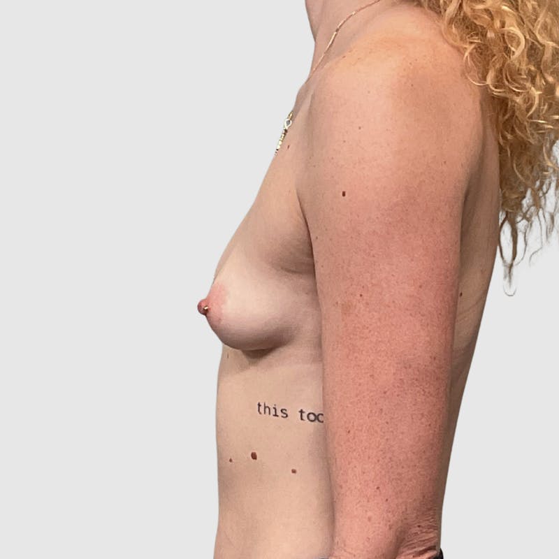 Breast Augmentation Before & After Gallery - Patient 247767 - Image 1