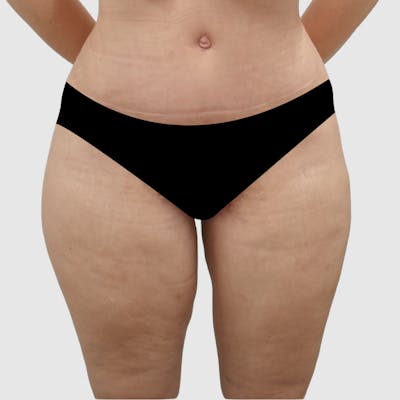 Thigh Lift Before & After Gallery - Patient 162741 - Image 2
