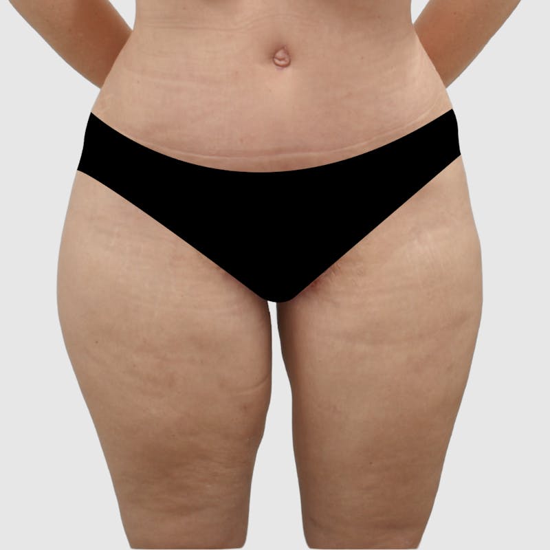 Thigh Lift Before & After Gallery - Patient 162741 - Image 2
