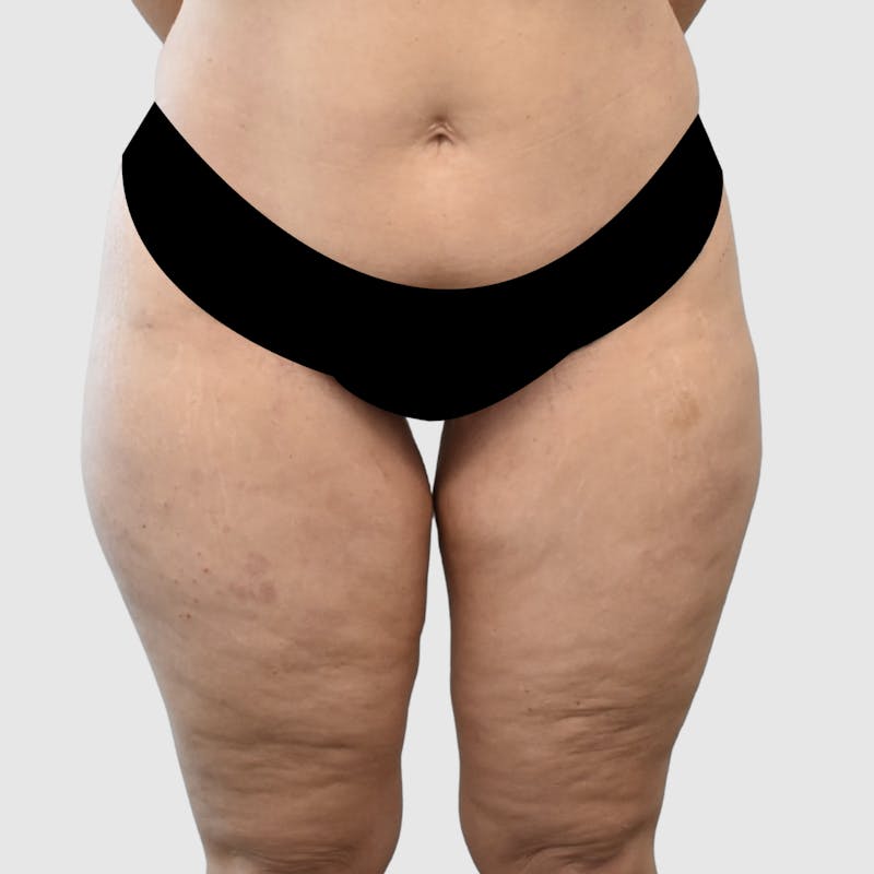 Thigh Lift Before & After Gallery - Patient 162741 - Image 1
