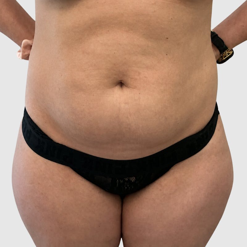 Liposuction Before & After Gallery - Patient 111423 - Image 1