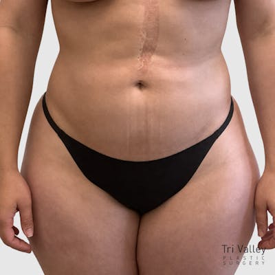 Liposuction Before & After Gallery - Patient 111423 - Image 2