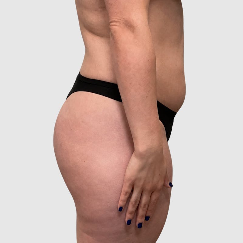 Liposuction Before & After Gallery - Patient 111423 - Image 3