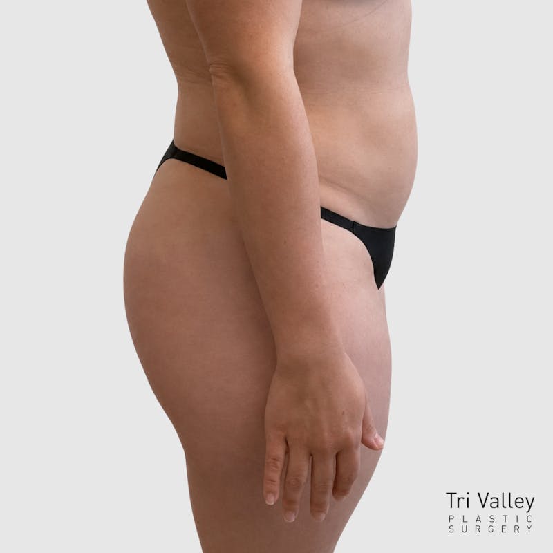 Liposuction Before & After Gallery - Patient 111423 - Image 4