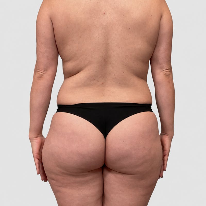 Liposuction Before & After Gallery - Patient 111423 - Image 5