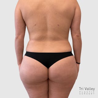 Liposuction Before & After Gallery - Patient 111423 - Image 6
