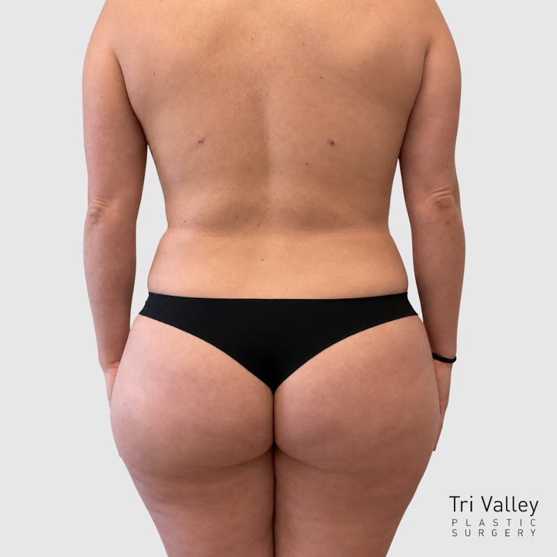 Liposuction Before & After Gallery - Patient 111423 - Image 6