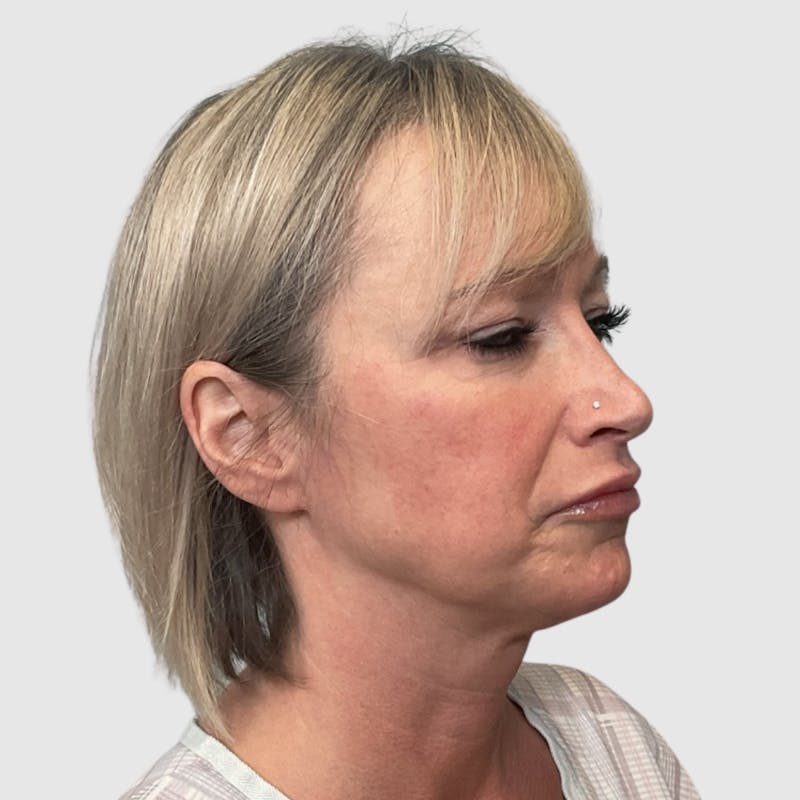 Face and Neck Lifts Before & After Gallery - Patient 312917 - Image 1