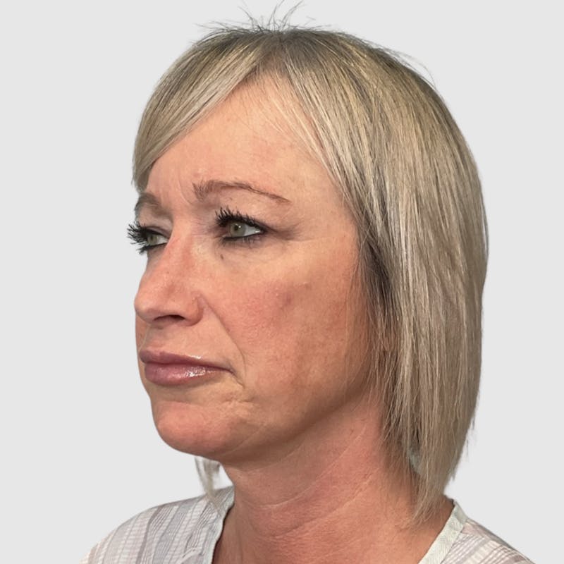 Face and Neck Lifts Before & After Gallery - Patient 312917 - Image 3