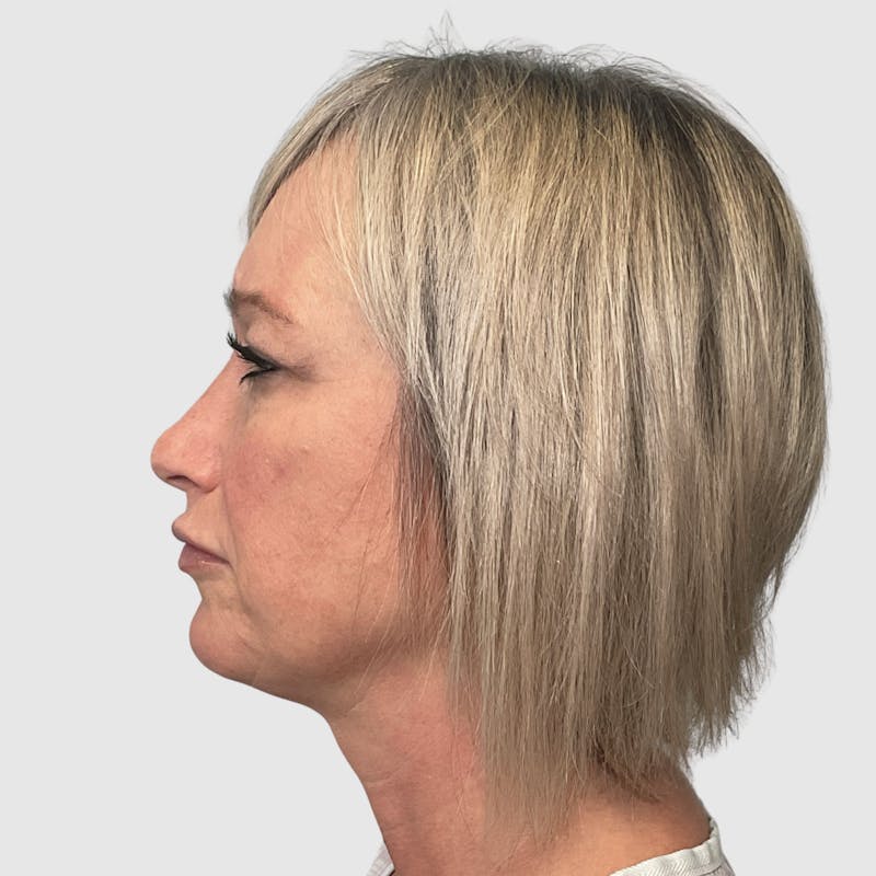 Face and Neck Lifts Before & After Gallery - Patient 312917 - Image 5