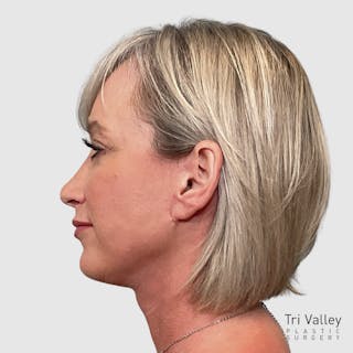 Face and Neck Lifts Before & After Gallery - Patient 312917 - Image 6
