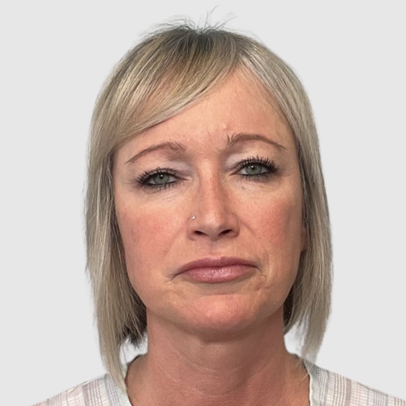 Face and Neck Lifts Before & After Gallery - Patient 312917 - Image 7