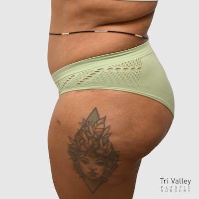 Brazilian Butt Lift Before & After Gallery - Patient 727786 - Image 2