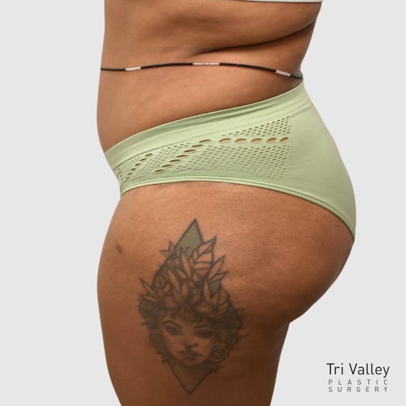 Brazilian Butt Lift Before & After Gallery - Patient 727786 - Image 2