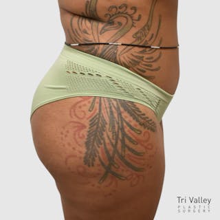 Brazilian Butt Lift Before & After Gallery - Patient 727786 - Image 4