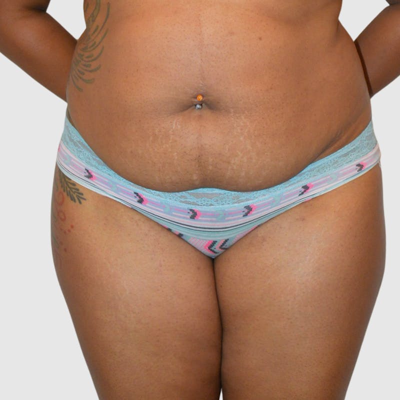 Brazilian Butt Lift Before & After Gallery - Patient 727786 - Image 5
