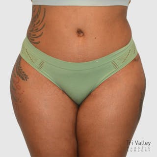 Brazilian Butt Lift Before & After Gallery - Patient 727786 - Image 6