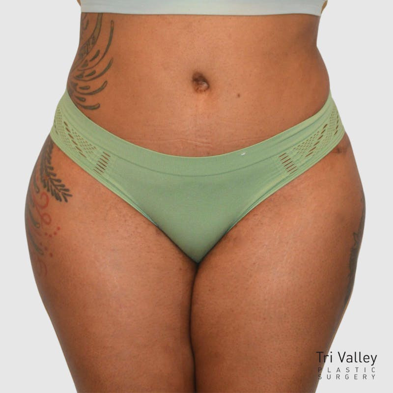 Brazilian Butt Lift Before & After Gallery - Patient 727786 - Image 6