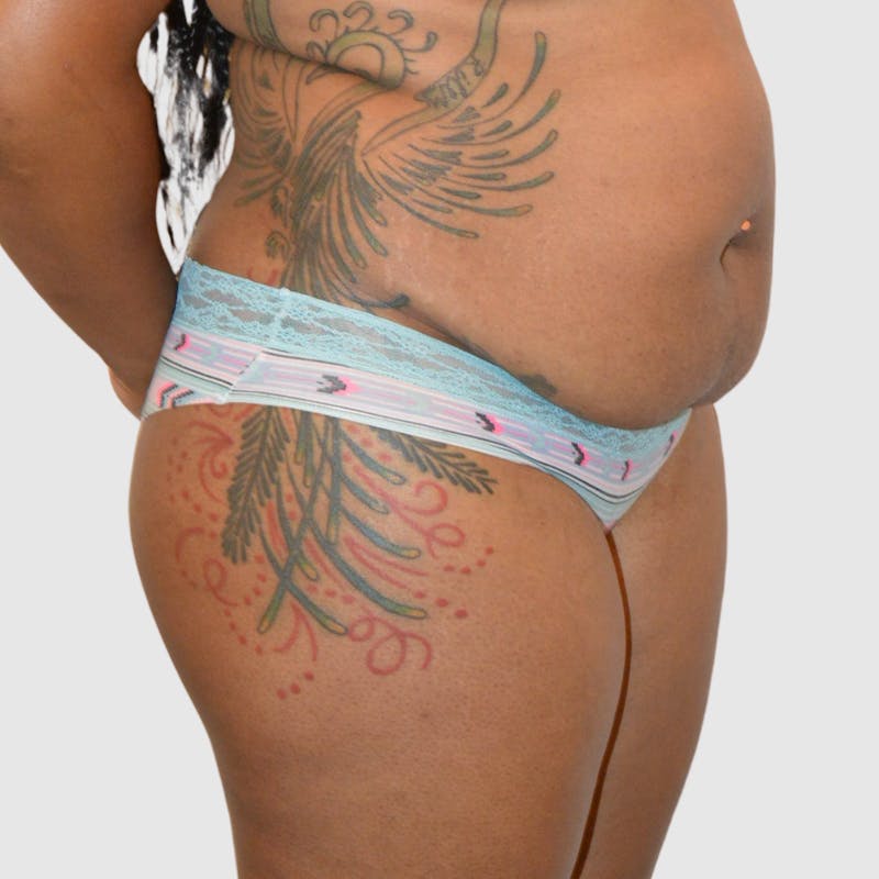 Brazilian Butt Lift Before & After Gallery - Patient 727786 - Image 3