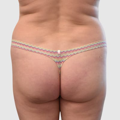 Brazilian Butt Lift Before & After Gallery - Patient 295941 - Image 1